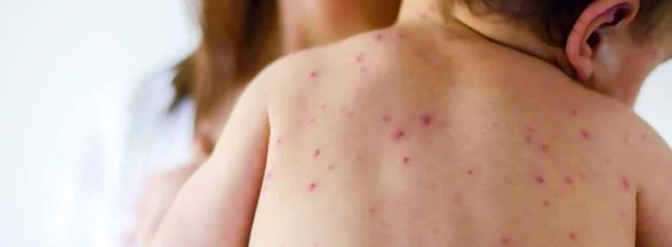 Noticia de Almera 24h: El sarampin es una enfermedad vrica muy contagiosa que afecta sobre todo a los nios